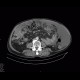 Carcinosis of the peritoneum: CT - Computed tomography